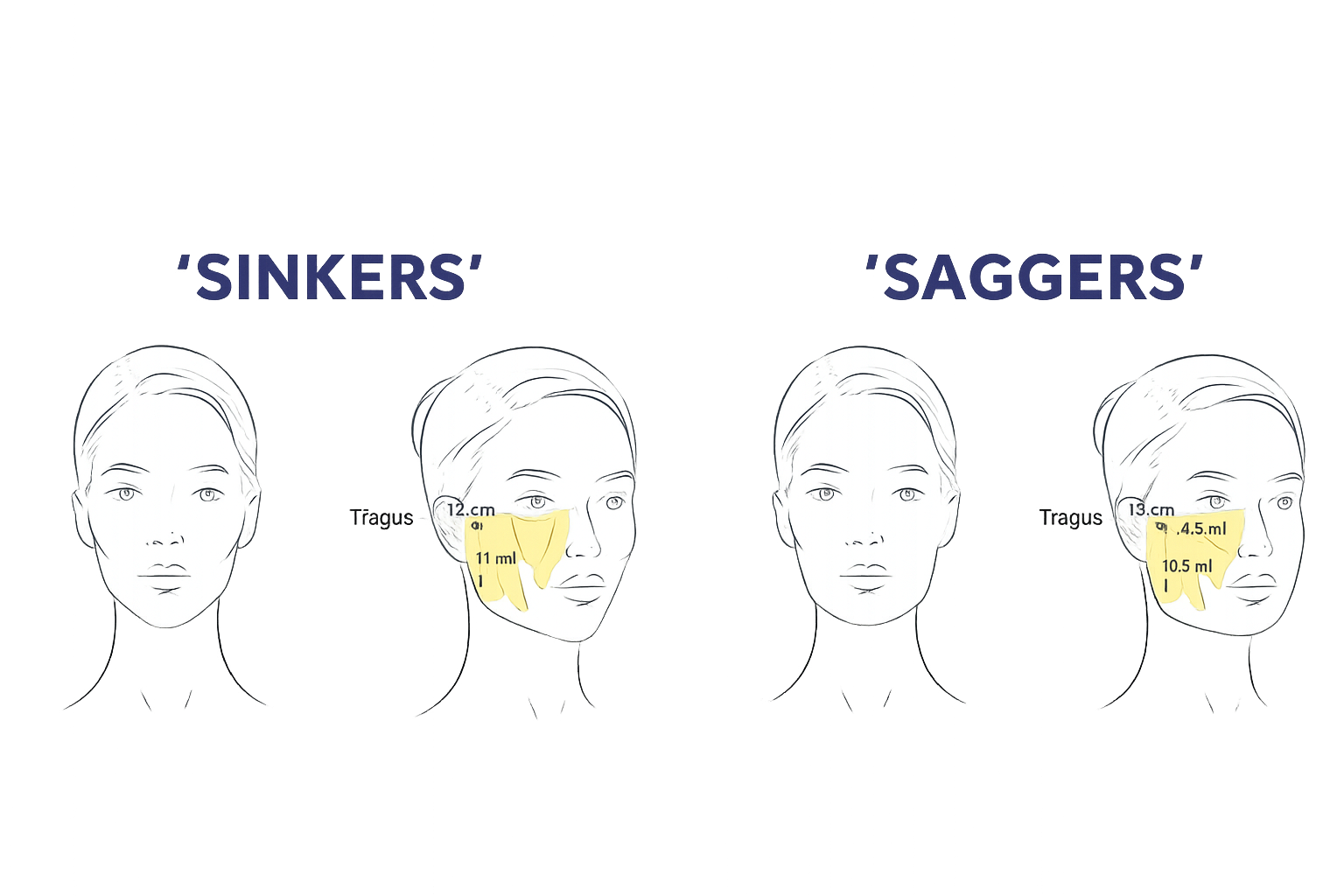Sinker und Sagger – Profhilo Structura